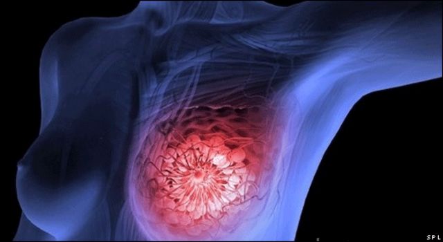Cáncer de mama, el más común: OMS (Aquí recomendaciones)