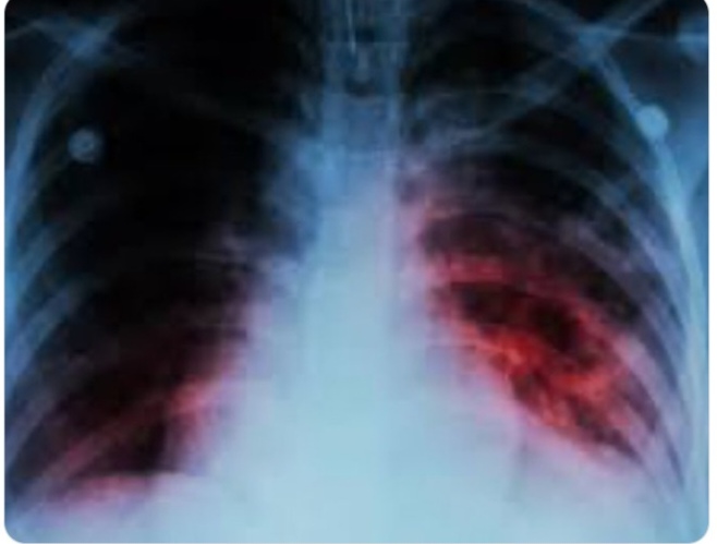 Alertan internacional por tuberculosis